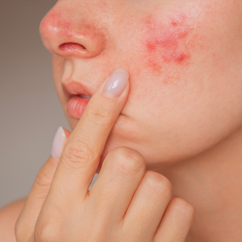 Huile de nigelle pour les rougeurs et cicatrices du visage